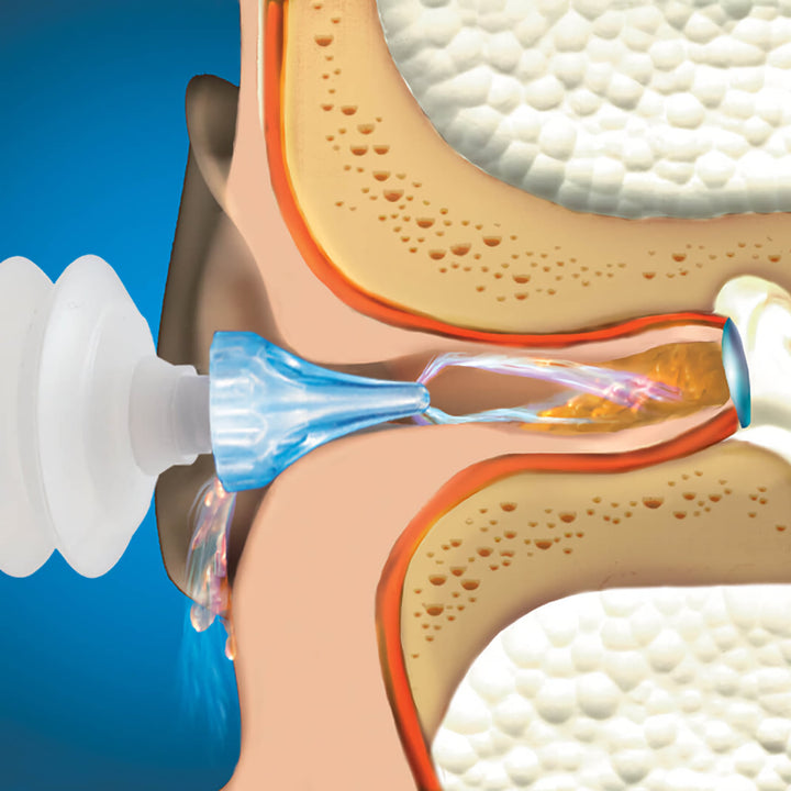 Diagram showing Mack's ProRinse syringe flushing earwax with triple stream water flow in ear canal